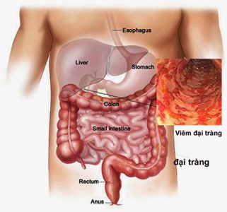 3 sai lầm khiến người viêm đại tràng không bao giờ thoát khỏi 