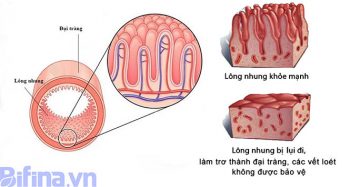 3 sai lầm khiến người viêm đại tràng không bao giờ thoát khỏi 