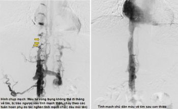 Điều trị thành công ca mắc hội chứng Budd-Chiari hiếm gặp 