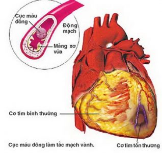 Hút thuốc thời gian dài gây tổn thương lớp nội mạc mạch máu, dẫn tới  sự co thắt mạn tính cho mạch máu, khiến cơ tim bị tổn thương.