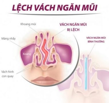 Lệch vách ngăn mũi cũng là nguyên nhân gây nghẹt mũi.