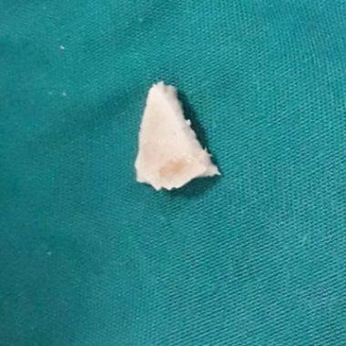 Gắp mảnh xương ở thanh quản bệnh nhi 19 tháng tuổi Ảnh 2