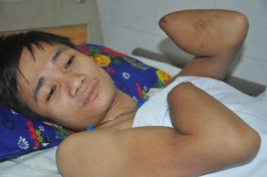 Bị điện cao thế phóng cụt tay chân, ông bố trẻ tỉnh dậy hét lên hoảng loạn - 1