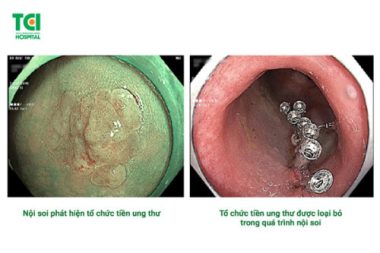 4 hiểu lầm về nội soi tiêu hóa