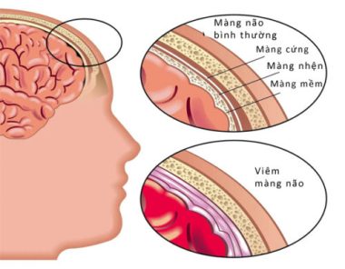 Căn bệnh viêm màng não nguy hiểm như thế nào?