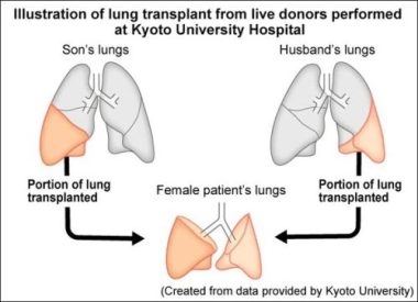 Lần đầu tiên trên thế giới: Ghép phổi từ 2 người sống cho bệnh nhân COVID-19 - Ảnh 2.
