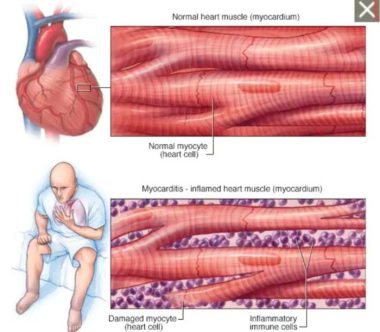 Nhóm người nào dễ mắc viêm cơ tim sau tiêm vắc xin Covid-19?