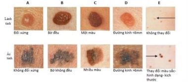 Khi nào nốt ruồi cảnh báo bạn mắc ung thư? - Ảnh 1.