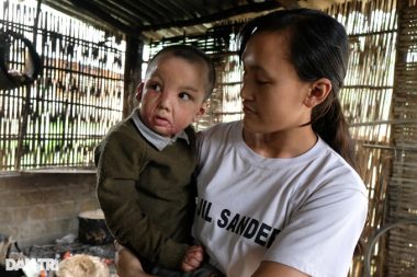 Cậu bé biến dạng khuôn mặt vì ngã vào nước nóng, gần 4 tuổi chưa biết nói - 2