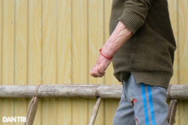 Cậu bé biến dạng khuôn mặt vì ngã vào nước nóng, gần 4 tuổi chưa biết nói - 6