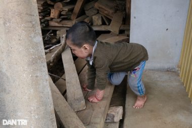 Cậu bé biến dạng khuôn mặt vì ngã vào nước nóng, gần 4 tuổi chưa biết nói - 8