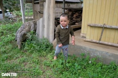 Cậu bé biến dạng khuôn mặt vì ngã vào nước nóng, gần 4 tuổi chưa biết nói - 10